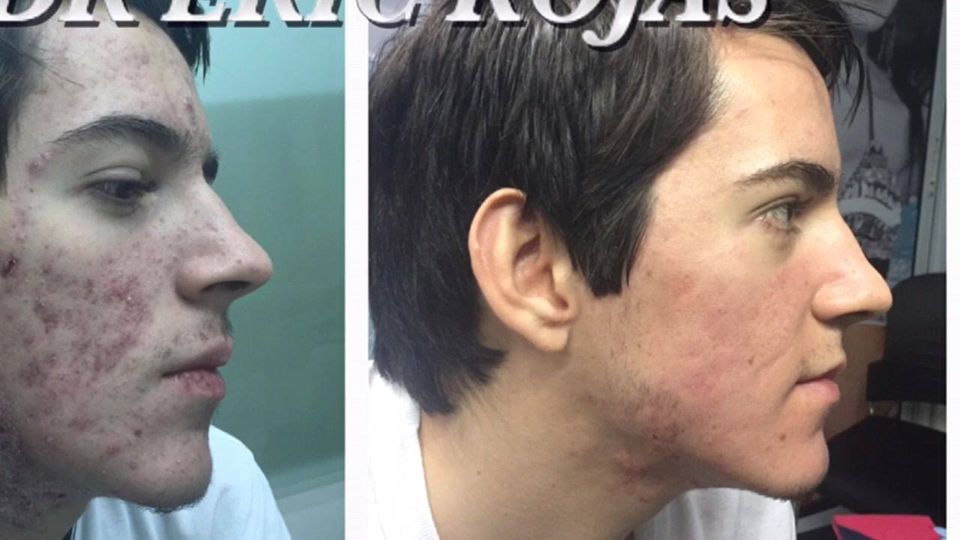 Somos un centro medico especializado en tratamiento y cura del acné