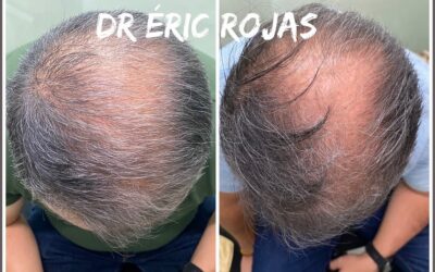 CAÍDA DE CABELLO YA NO MÁS