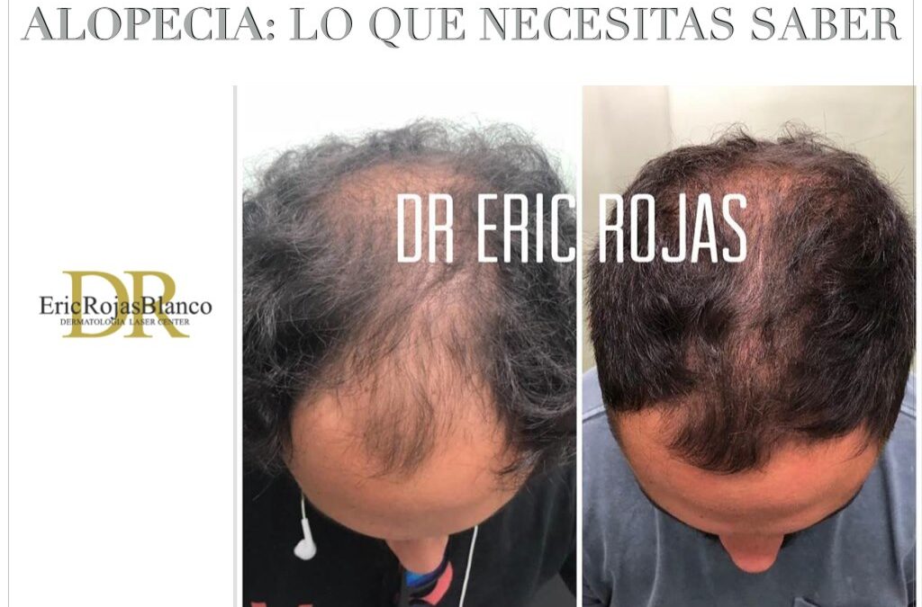¡Existen distintos tipos y diferentes causas las que originan la alopecia!