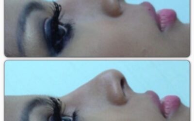 NARIZ PERFECTA DR ÉRIC ROJAS 22483535