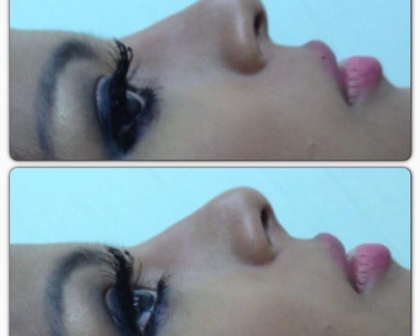 NARIZ PERFECTA DR ÉRIC ROJAS 22483535