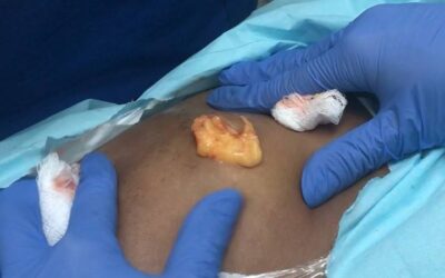 Lipoma es un tumor de grasa que se debe eliminar.