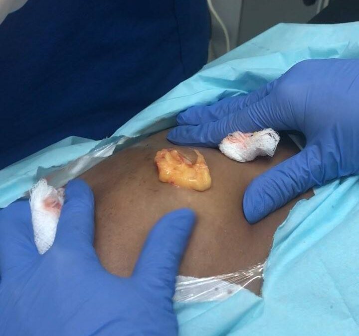Lipoma es un tumor de grasa que se debe eliminar.