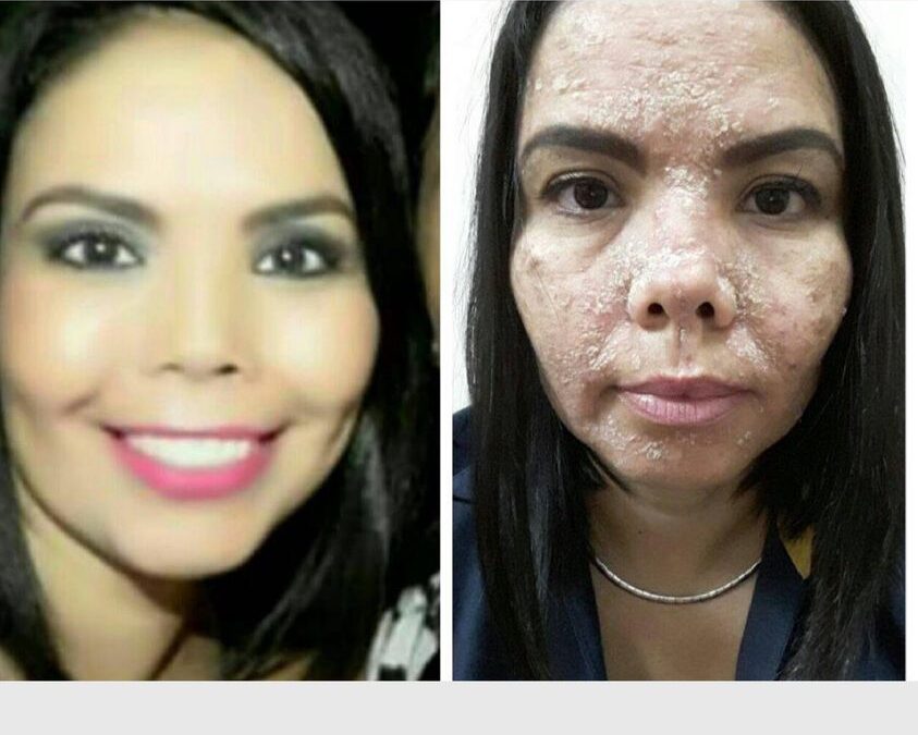 Eliminamos todo tipo de problemas en tu piel !