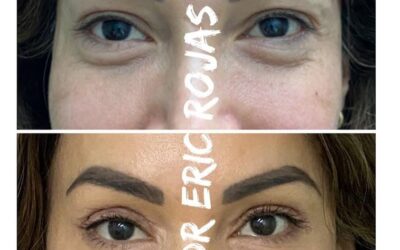 Rejuvenecimiento Facial