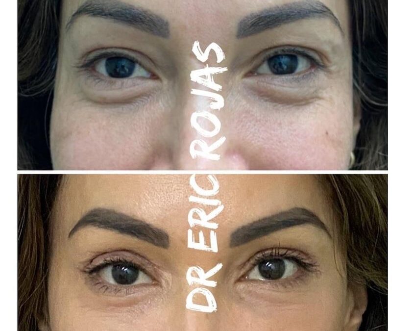 Rejuvenecimiento Facial