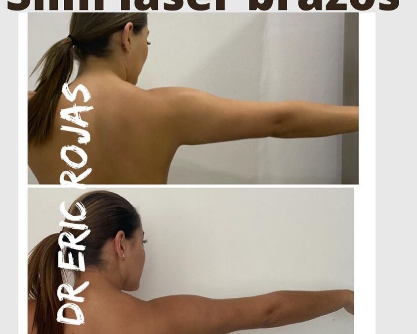 Slim laser en Brazos