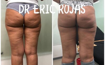Tratamiento para disminuir las celulitis