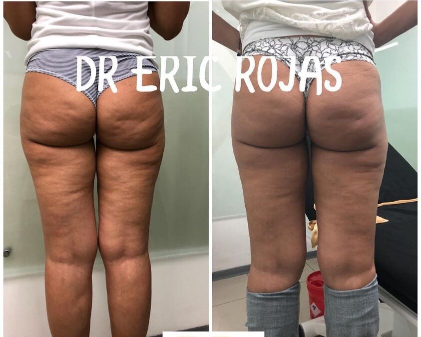 Tratamiento para disminuir las celulitis