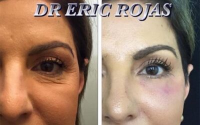 Rejuvenecimiento Facial