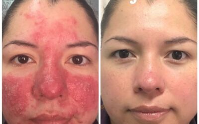 Psoriasis
