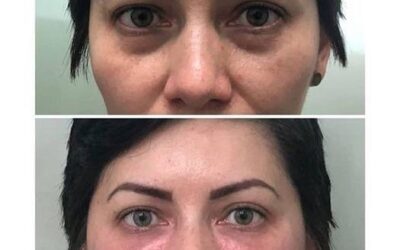 Rejuvenecimiento Facial
