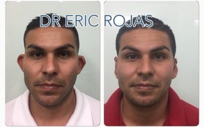 Corrección de orejas