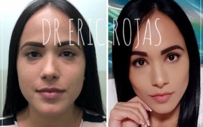 Perfilado facial