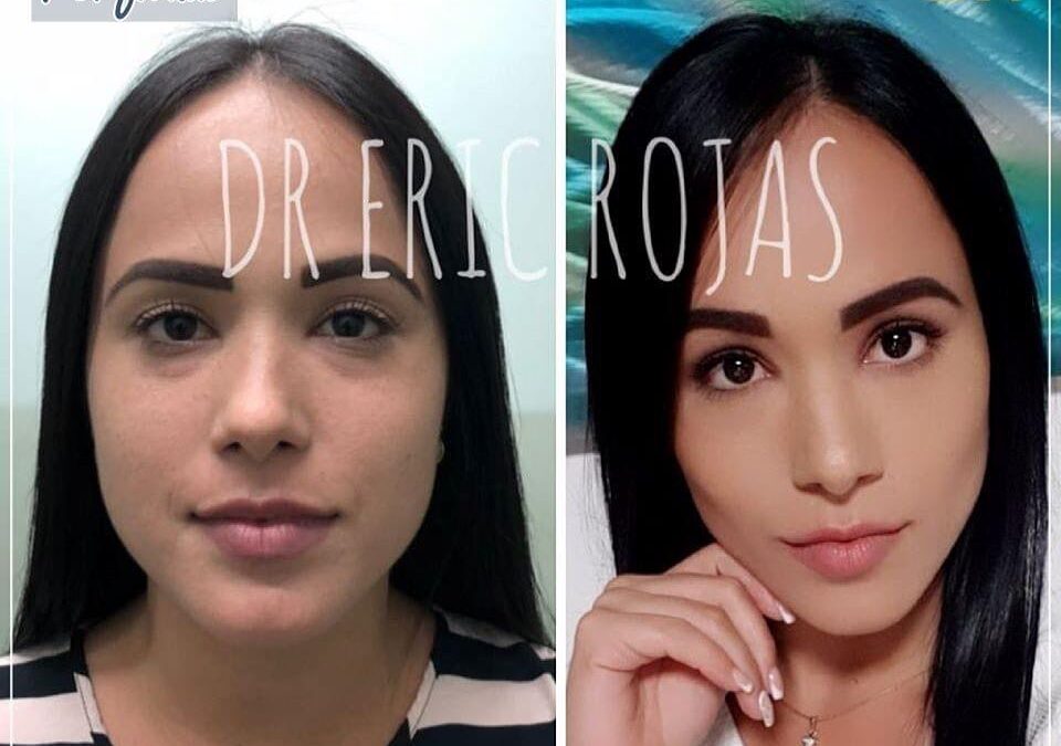 Perfilado facial