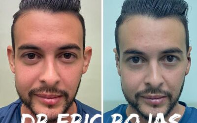 Corrección de orejas