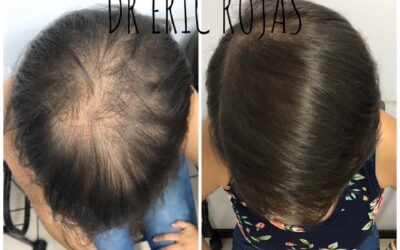 Ya no más pérdida de cabello
