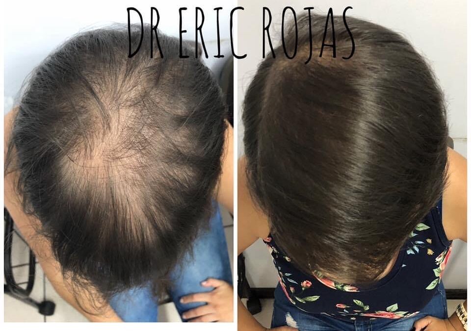 Ya no más pérdida de cabello