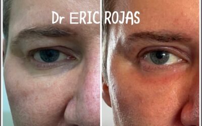 DERMABLEFAROPLASTIA LÁSER PARA LEVANTAR TU MIRADA