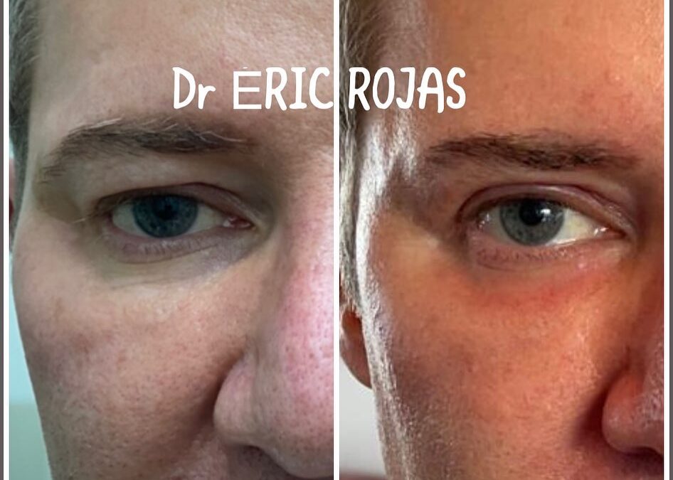 DERMABLEFAROPLASTIA LÁSER PARA LEVANTAR TU MIRADA