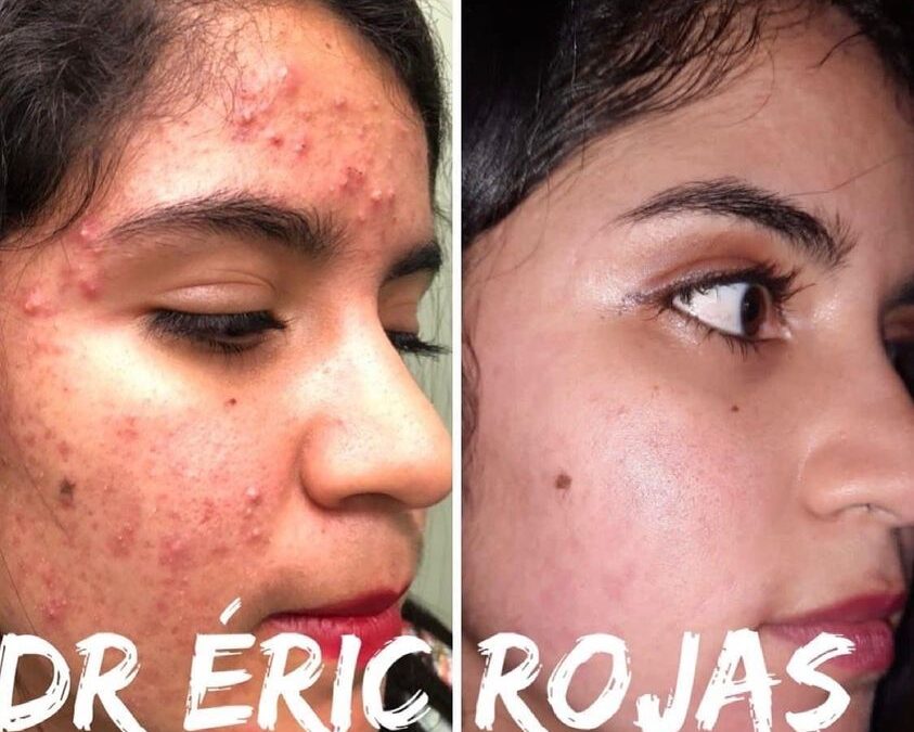 Eliminación de acné