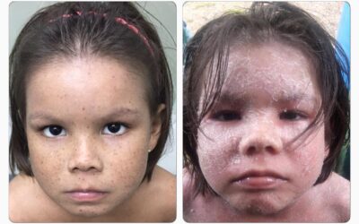 DERMATITIS ATOPICA