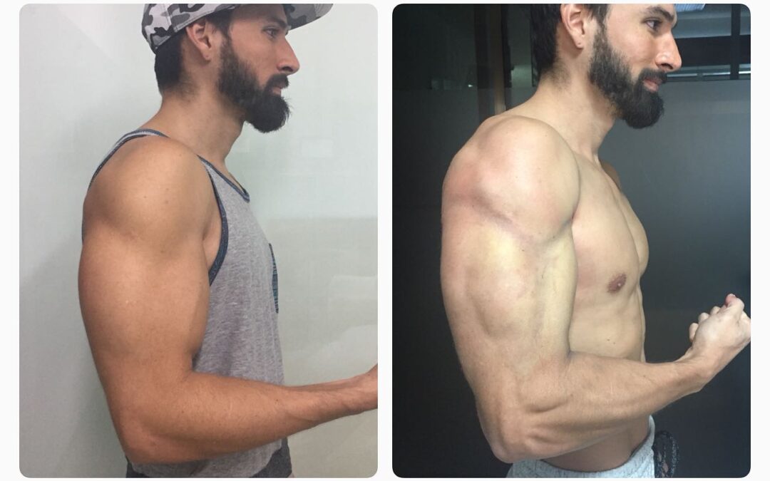 Marcación de brazos