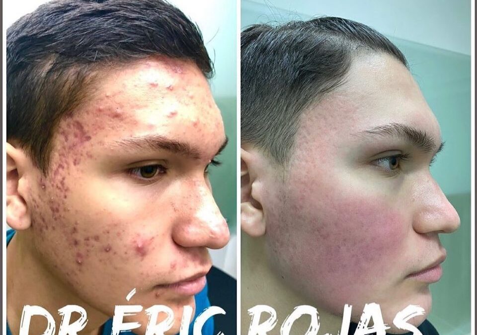 El acné tiene cura.