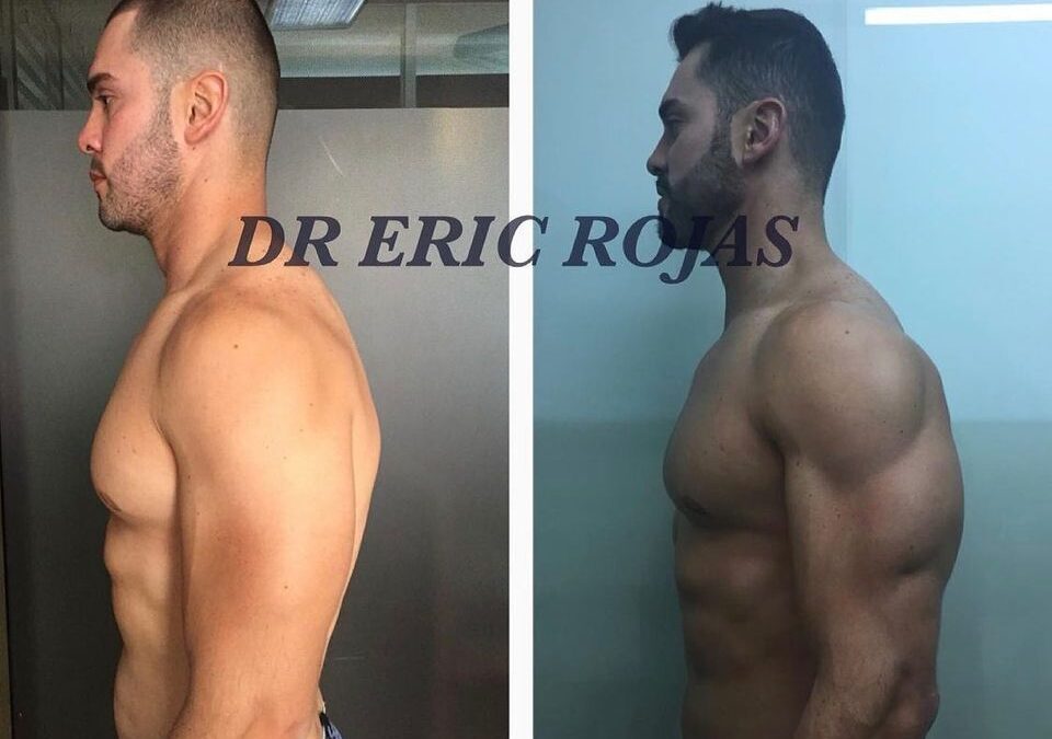 Marcación de brazos