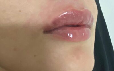 Relleno y definición de labios