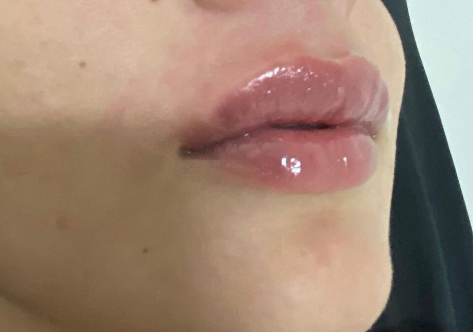 Relleno y definición de labios