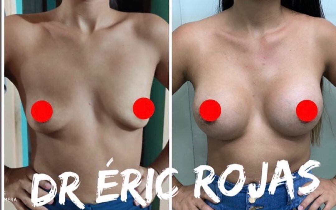Aumento mamario!