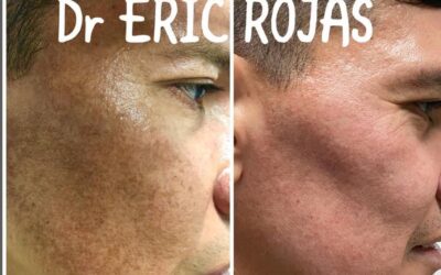 Te ayudamos a Eliminar las manchas en tu piel