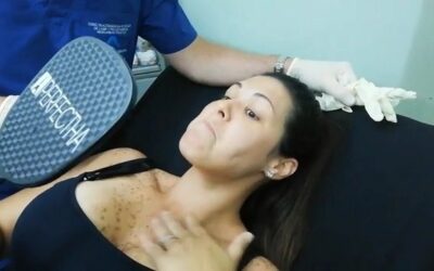 NEVUS RUBÍ