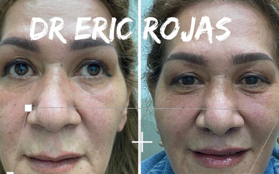 Acotamiento de labio superior para rejuvenecer el rostro