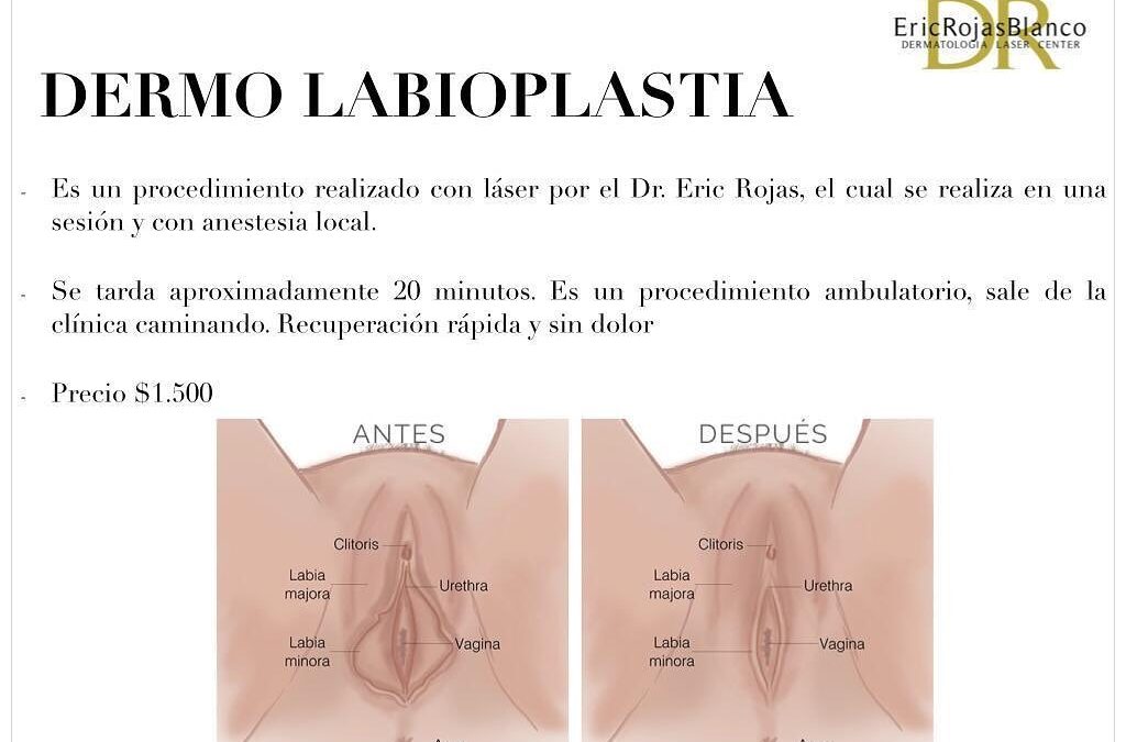 Dermolabioplastia