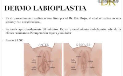 Dermolabioplastia