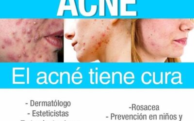Me están empezando a salir espinillas ¿Qué puedo hacer para quitármelos?