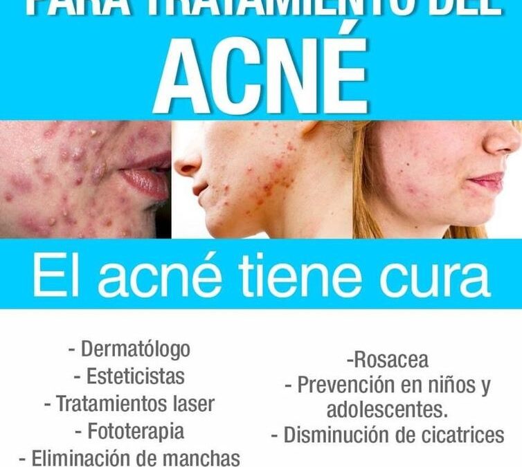 Me están empezando a salir espinillas ¿Qué puedo hacer para quitármelos?