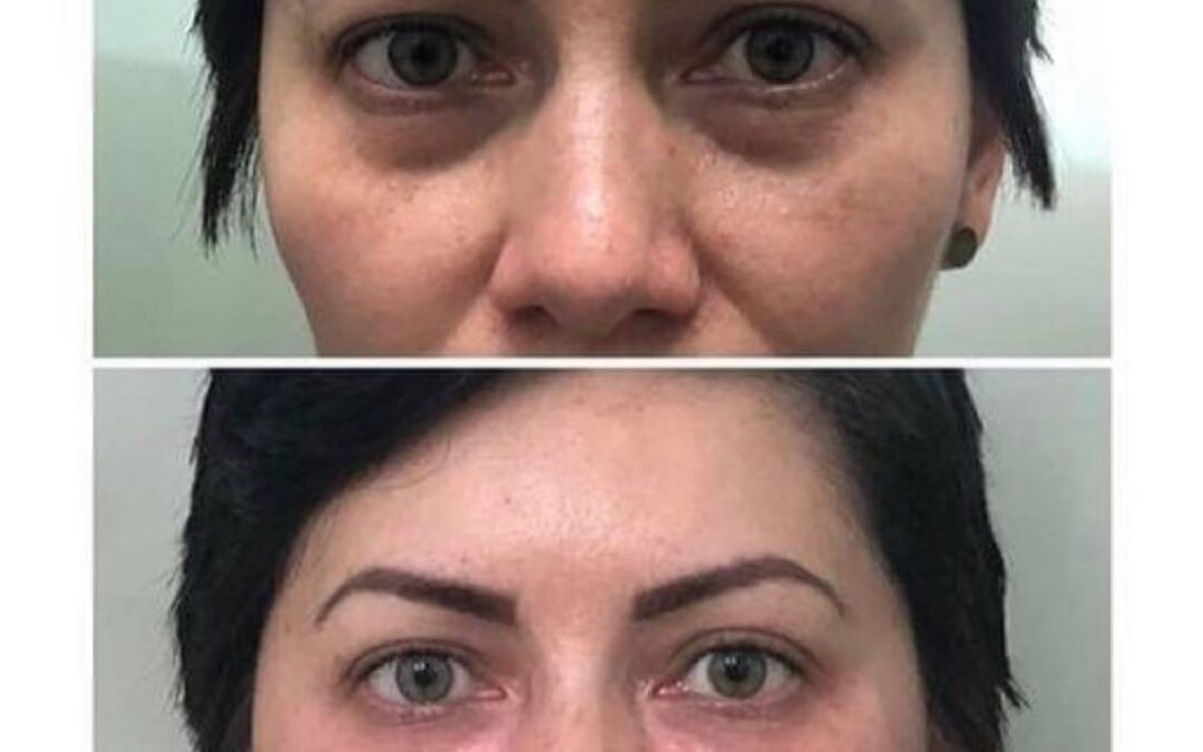 Rejuvenecimiento Facial