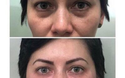 Rejuvenecimiento Facial