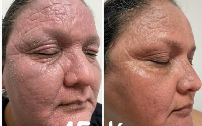 Dermatitis severa