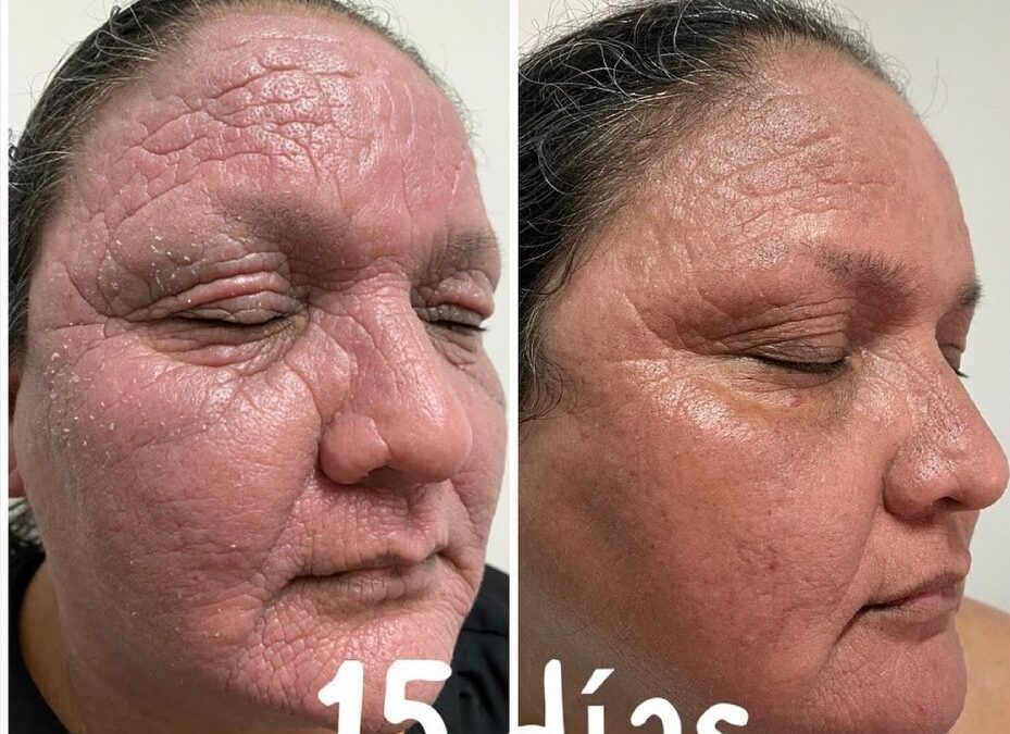 Dermatitis severa