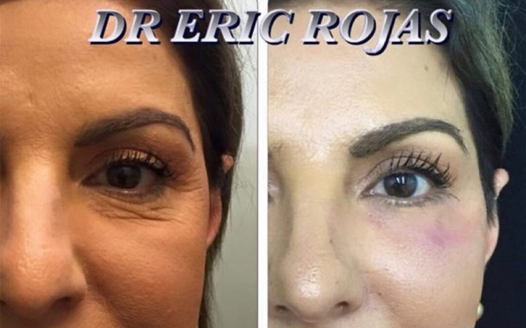 Ya no más ojeras