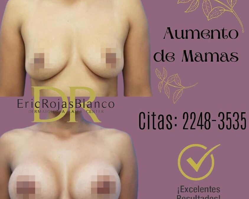 Aumento mamario