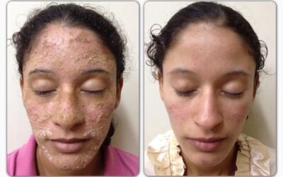Dermatitis seborreica