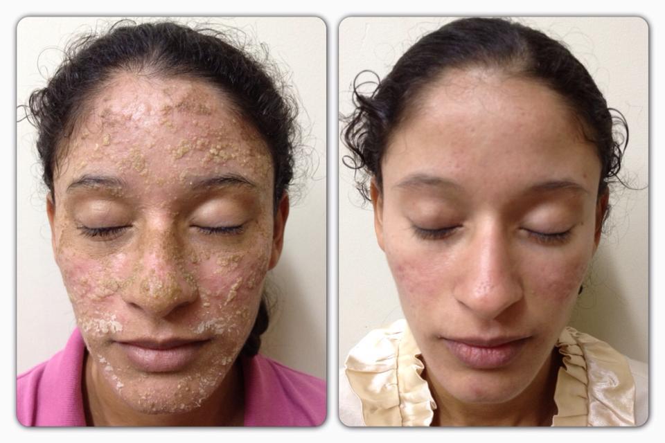 Dermatitis seborreica