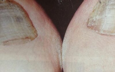 Onicomicosis u hongos