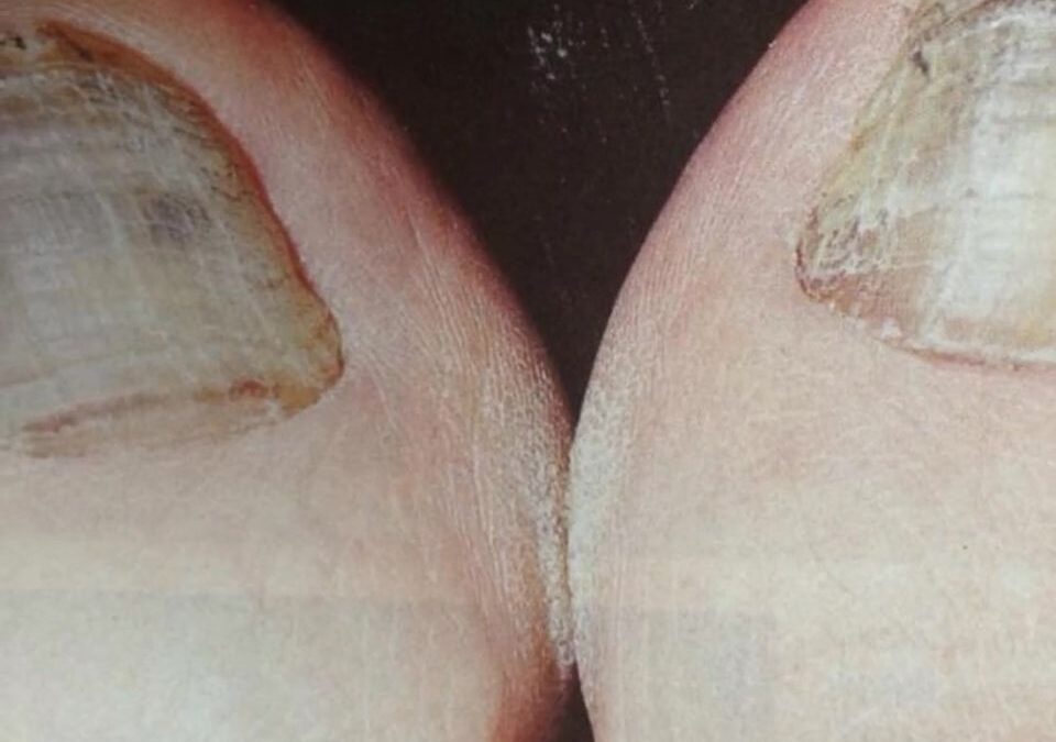 Onicomicosis u hongos