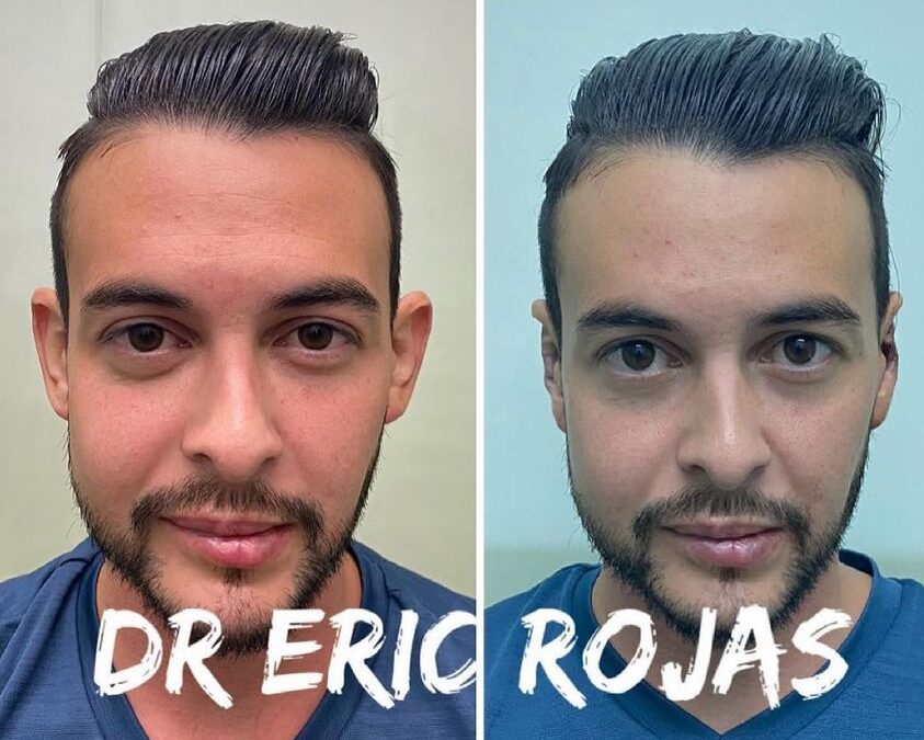 Corrección de orejas